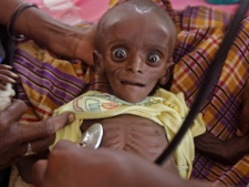 A doctor examines Mihag Gedi Farah, a seven-month-old child with a weight of 3.4 kg, in a field hospital of the International Rescue Committee in the town of Dadaab, Kenya on Tuesday, July 26, 2011. (AP Photo/Schalk van Zuydam)