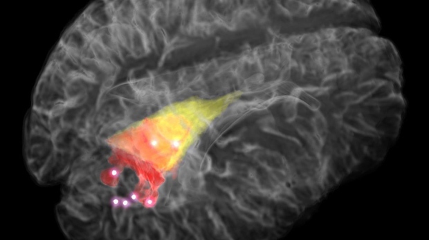 Fibre-optic 'pen' can detect stray brain cancer cells: study | CP24.com