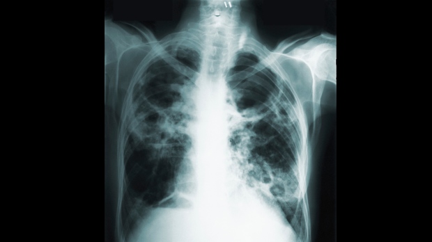 tuberculosis, patient