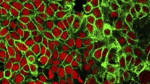 FILE - This microscope image made available by the National Cancer Institute Center for Cancer Research in 2015 shows human colon cancer cells with the nuclei stained red. Cancer is a disease of the genome, or full set of instructions for running cells, that occurs when changes in a person’s DNA cause cells to grow and divide uncontrollably. (NCI Center for Cancer Research via AP)