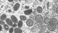 This 2003 electron microscope image made available by the U.S. Centers for Disease Control and Prevention shows mature, oval-shaped monkeypox virions, left, and spherical immature virions, right, obtained from a sample of human skin associated with the 2003 prairie dog outbreak. (Cynthia S. Goldsmith, Russell Regner/CDC via AP)