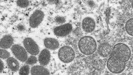 This 2003 electron microscope image made available by the Centers for Disease Control and Prevention shows mature, oval-shaped monkeypox virions, left, and spherical immature virions, right, obtained from a sample of human skin associated with the 2003 prairie dog outbreak.  (Cynthia S. Goldsmith, Russell Regner/CDC via AP)