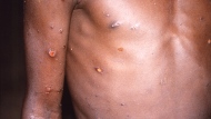 This 1997 image provided by CDC, shows the right arm and torso of a patient, whose skin displayed a number of lesions due to what had been an active case of monkeypox.  As more cases of monkeypox are detected in Europe and North America in 2022, some scientists who have monitored numerous outbreaks in Africa say they are baffled by the unusual disease's spread in developed countries.  (CDC via AP)