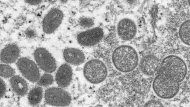 This 2003 electron microscope image made available by the Centers for Disease Control and Prevention shows mature, oval-shaped monkeypox virions, left, and spherical immature virions, right, obtained from a sample of human skin associated with the 2003 prairie dog outbreak. THE CANADIAN PRESS/CDC via AP,-Cynthia S. Goldsmith, Russell Regner