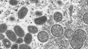 FILE - This 2003 electron microscope image made available by the Centers for Disease Control and Prevention shows mature, oval-shaped monkeypox virions, left, and spherical immature virions, right, obtained from a sample of human skin associated with the 2003 prairie dog outbreak. British health officials said Monday, June 13, 2022 they have detected another 104 cases of monkeypox in England, in what has become the biggest outbreak beyond Africa of the normally rare disease. (Cynthia S. Goldsmith, Russell Regner/CDC via AP, file)