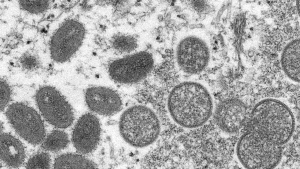 FILE - This 2003 electron microscope image made available by the Centers for Disease Control and Prevention shows mature, oval-shaped monkeypox virions, left, and spherical immature virions, right, obtained from a sample of human skin associated with the 2003 prairie dog outbreak. Africa’s public health agency says it doesn’t know how many of the continent's reported monkeypox cases this year are in men who have sex with men, and it warned Thursday, Aug. 4, 2022 against “any stigmatization” that might delay case reporting and affect the outbreak response. (Cynthia S. Goldsmith, Russell Regner/CDC via AP, File)