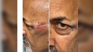 Brampton election candidate Raman Vasudev got a black eye and scrapes near his temples in an alleged “unprovoked attack” on Tuesday.