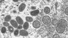 Mpox virus