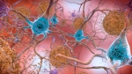 This illustration made available by the National Institute on Aging/National Institutes of Health depicts cells in an Alzheimer's affected brain, with abnormal levels of the beta-amyloid protein clumping together to form plaques, brown, that collect between neurons and disrupt cell function. (National Institute on Aging, NIH via AP)