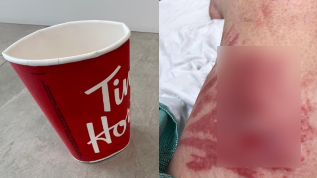 The cup that Lansing claims was not structurally sound can be seen on the left, (Gardiner Roberts LLP), alongside a photo of a burn suffered by Lansing (Tighe).