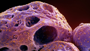 More people died in Canada in 2021 than the previous year, with cancer, heart disease, overdoses and COVID-19 cited as the leading causes of death. This colourized electron microscope image made available by the National Institute of Allergy and Infectious Diseases in November 2022, shows cells, indicated in purple, infected with the omicron strain of the SARS-CoV-2 virus, orange, isolated from a patient sample, captured at the NIAID Integrated Research Facility (IRF) in Fort Detrick, Md. THE CANADIAN PRESS/AP-HO, NIAID/NIH