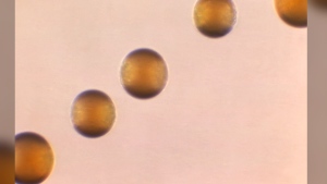 This 1966 microscope photo shows five colonies of Group-B Neisseria meningitidis bacteria. On Thursday, March 28, 2024, the CDC issued an alert to U.S. doctors about an increase in cases of one type of invasive meningococcal disease, mostly due to the serogroup Y strain of the bacteria. Four hundred and twenty two cases were reported in 2023, which was the most in a single year since 2014. There have been 143 reported this year so far. (Dr. Brodsky/CDC via AP)