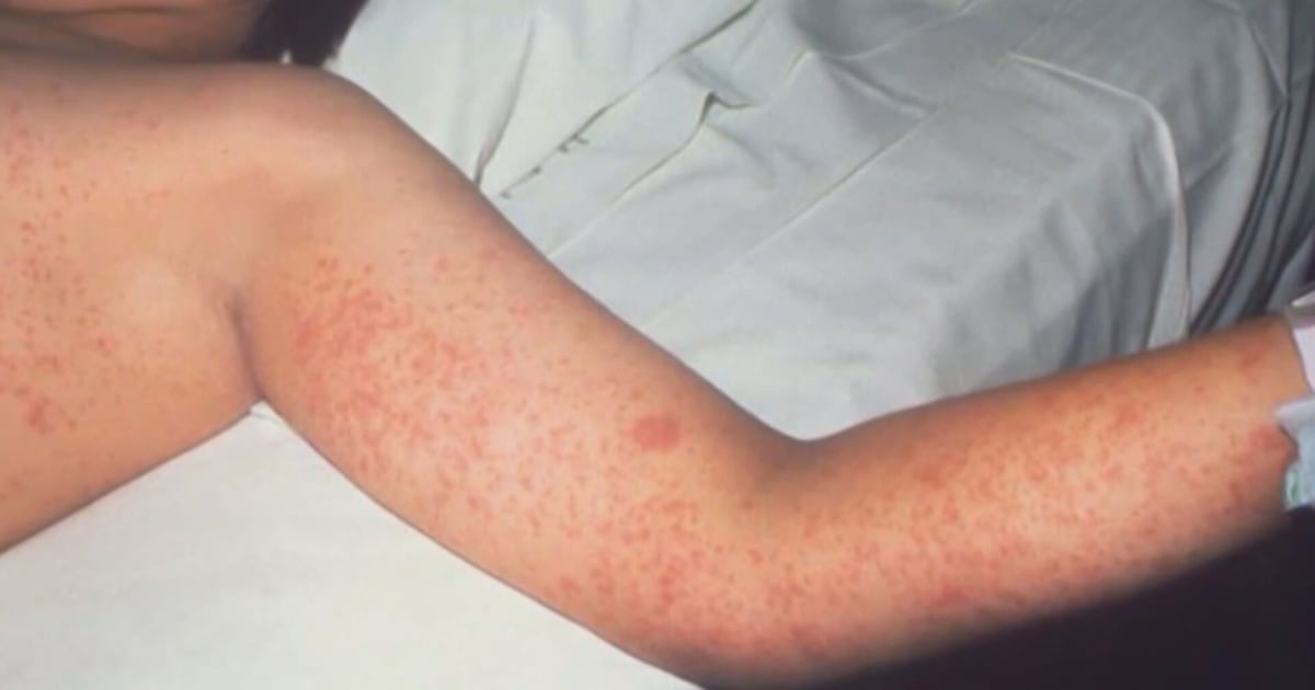 Child from Hamilton contracts measles Child from Hamilton contracts measles
