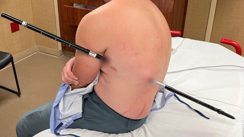 Nurse forced to hike 16 kilometres for help after being impaled by pole