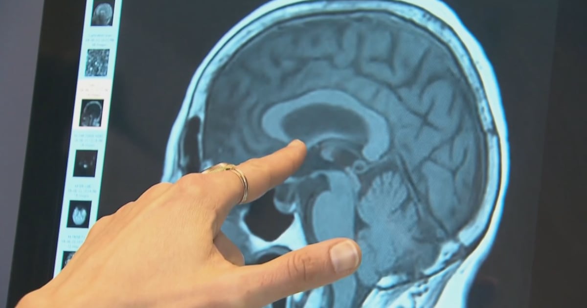 Ultra-processed foods linked to brain damage and dementia risk, study finds